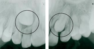 Impacted Upper Canines